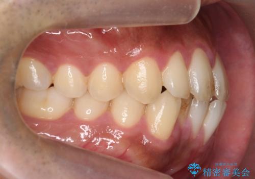 前歯が反対にかんでいる　部分ワイヤーとインビザラインの併用で短期治療の治療前
