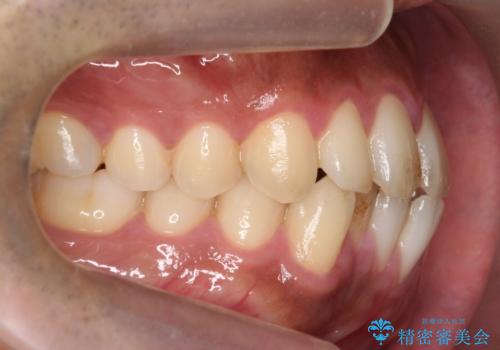 前歯が反対にかんでいる 部分ワイヤーとインビザラインの併用で短期治療の治療前