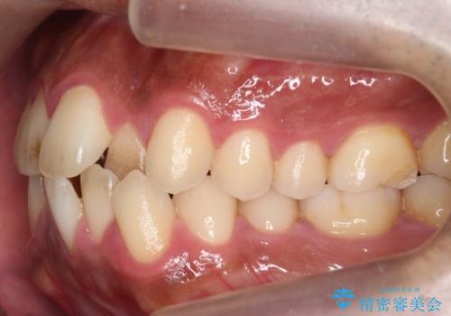 前歯が反対にかんでいる 部分ワイヤーとインビザラインの併用で短期治療の治療前