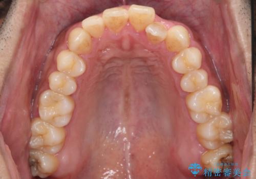 前歯が反対にかんでいる 部分ワイヤーとインビザラインの併用で短期治療の治療前