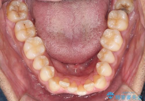 前歯が反対にかんでいる 部分ワイヤーとインビザラインの併用で短期治療の治療前