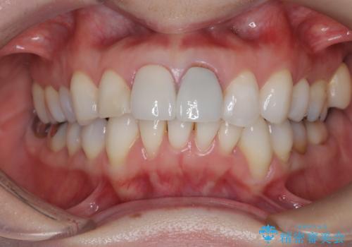 【オールセラミッククラウン】前歯の色が気になる!の治療前