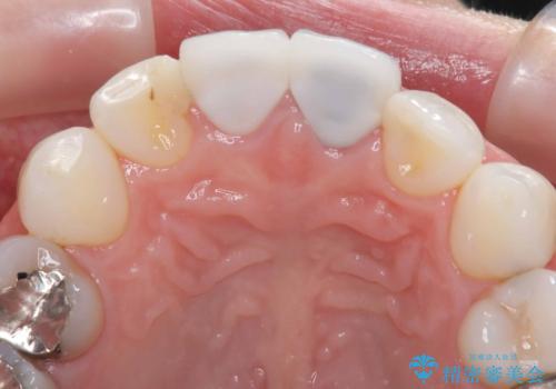 【オールセラミッククラウン】前歯の色が気になる!の治療前