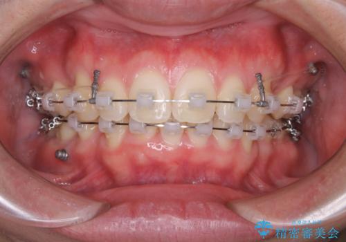 がたつき、口ゴボ(出っ歯)、真ん中のずれを抜歯矯正治療で治す。ワイヤー矯正治療の治療中
