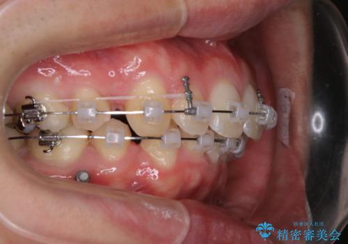 がたつき、口ゴボ(出っ歯)、真ん中のずれを抜歯矯正治療で治す。ワイヤー矯正治療の治療中