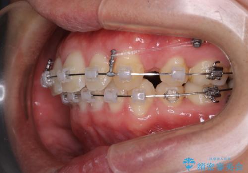 がたつき、口ゴボ(出っ歯)、真ん中のずれを抜歯矯正治療で治す。ワイヤー矯正治療の治療中