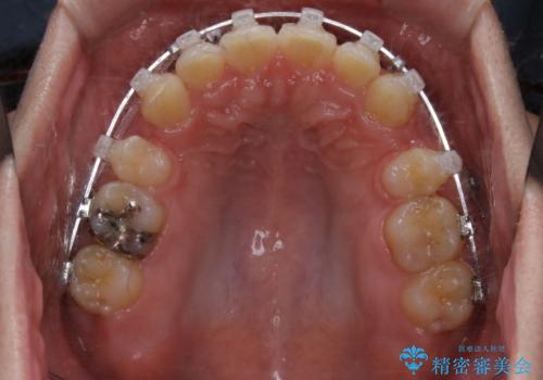 がたつき、口ゴボ(出っ歯)、真ん中のずれを抜歯矯正治療で治す。ワイヤー矯正治療の治療中