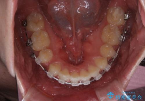 がたつき、口ゴボ(出っ歯)、真ん中のずれを抜歯矯正治療で治す。ワイヤー矯正治療の治療中