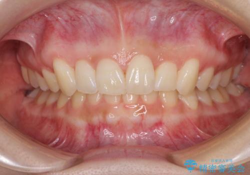 前歯のデコボコを治したい インビザライン矯正治療の治療中