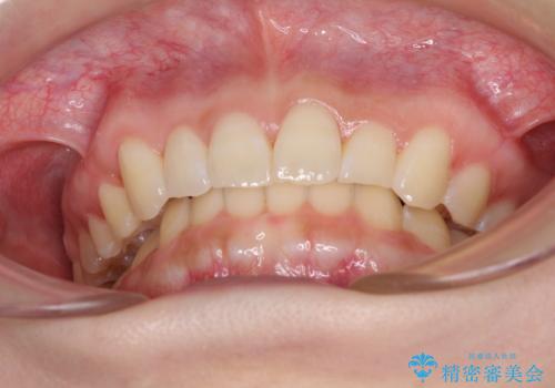 前歯のデコボコを治したい インビザライン矯正治療の治療中