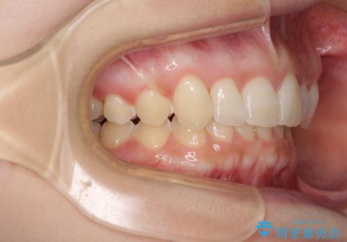 前歯のデコボコを治したい インビザライン矯正治療の治療中