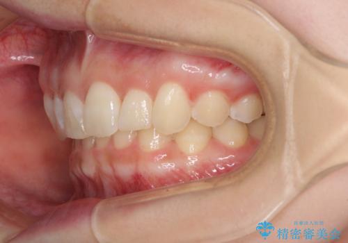 前歯のデコボコを治したい インビザライン矯正治療の治療中