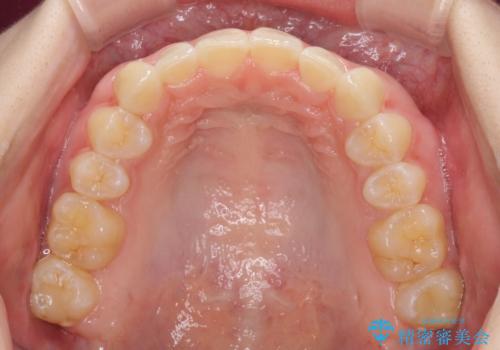 前歯のデコボコを治したい インビザライン矯正治療の治療中