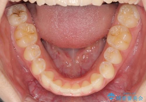 前歯のデコボコを治したい インビザライン矯正治療の治療中