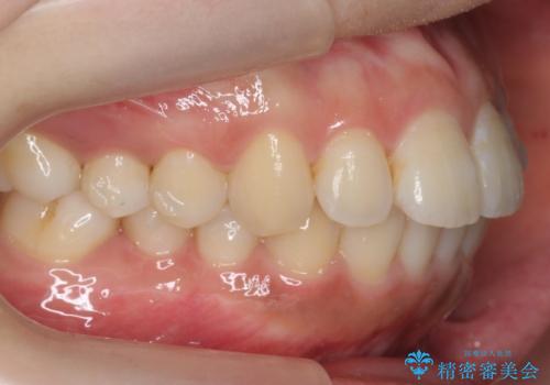 前歯の並び　モニター治療での治療中
