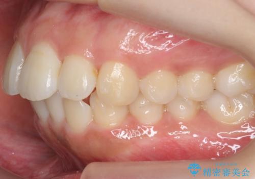 前歯の並び モニター治療での治療中