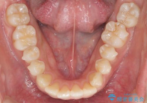 前歯の並び モニター治療での治療中
