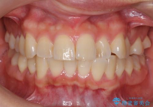 前歯と奥歯の反対咬合 部分ワイヤーとインビザラインでの治療前