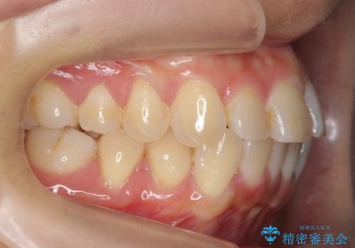前歯と奥歯の反対咬合 部分ワイヤーとインビザラインでの治療前