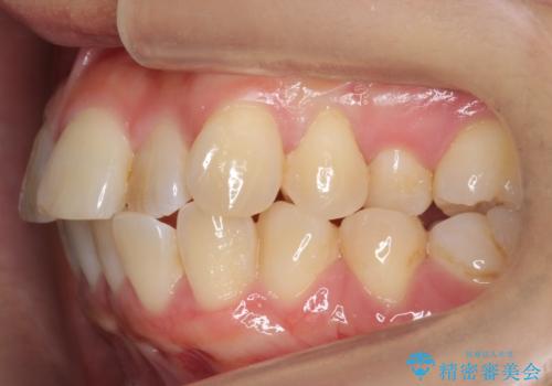 前歯と奥歯の反対咬合　部分ワイヤーとインビザラインでの治療前