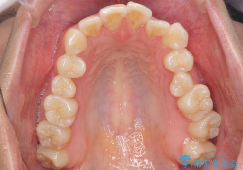 前歯と奥歯の反対咬合　部分ワイヤーとインビザラインでの治療前