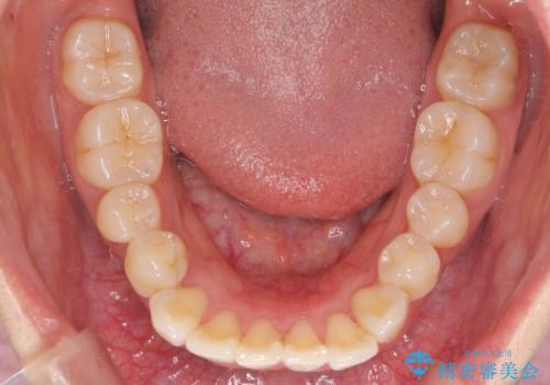 前歯と奥歯の反対咬合 部分ワイヤーとインビザラインでの治療前