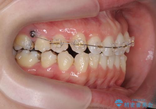 [ 引っ込んだ前歯を治したい ] 歯を抜かないマウスピース矯正の治療中