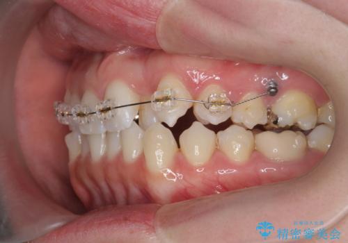 [ 引っ込んだ前歯を治したい ] 歯を抜かないマウスピース矯正の治療中