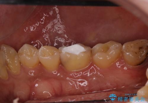 【根管治療】物が当たるだけで痛いの治療前