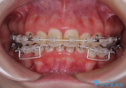 叢生・ディープバイト・突出　ワイヤー装置での抜歯矯正で全てを解決の治療中
