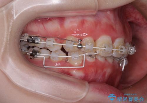 叢生・ディープバイト・突出　ワイヤー装置での抜歯矯正で全てを解決の治療中