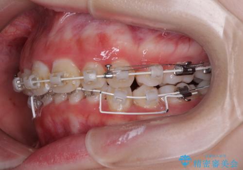 叢生・ディープバイト・突出 ワイヤー装置での抜歯矯正で全てを解決の治療中