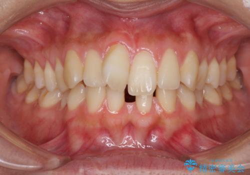 下顎前歯の欠損歯列　ワイヤー装置での矯正治療の症例 治療前