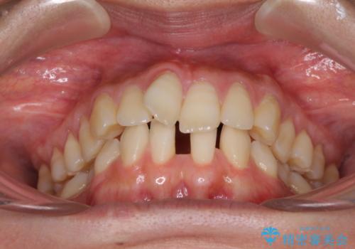 下顎前歯の欠損歯列 ワイヤー装置での矯正治療の治療前