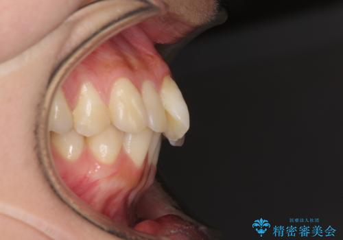 下顎前歯の欠損歯列 ワイヤー装置での矯正治療の治療前