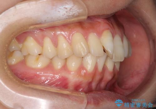 下顎前歯の欠損歯列 ワイヤー装置での矯正治療の治療前