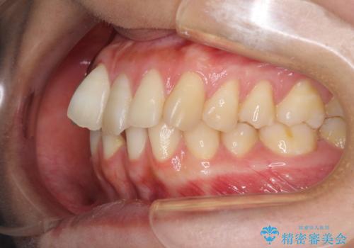 下顎前歯の欠損歯列　ワイヤー装置での矯正治療の治療前