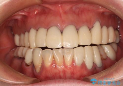 治療を開始したもののうまく噛めない 咬合改善のオールセラミック補綴治療の症例 治療前