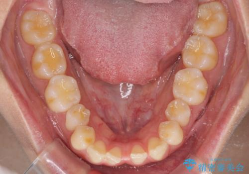 下顎前歯の欠損歯列 ワイヤー装置での矯正治療の治療前