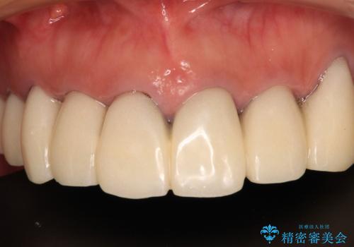 治療を開始したもののうまく噛めない 咬合改善のオールセラミック補綴治療の治療前