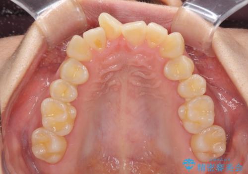 下顎前歯の欠損歯列 ワイヤー装置での矯正治療の治療前