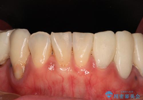 治療を開始したもののうまく噛めない 咬合改善のオールセラミック補綴治療の治療前