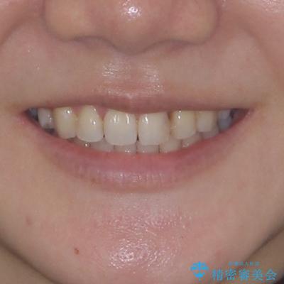 八重歯と正中のズレ ワイヤー装置での抜歯矯正の治療後(顔貌)