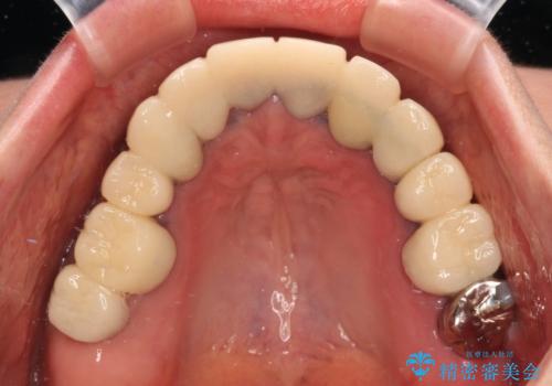 治療を開始したもののうまく噛めない 咬合改善のオールセラミック補綴治療の治療前
