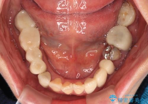 治療を開始したもののうまく噛めない 咬合改善のオールセラミック補綴治療の治療前