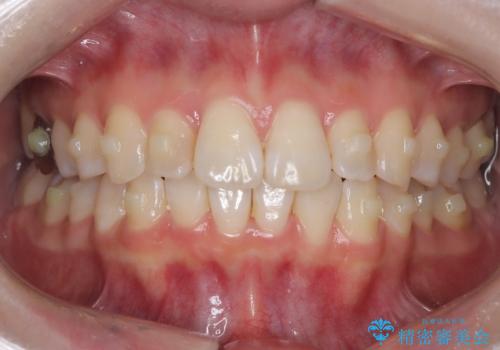 前歯のガタつきをマウスピース矯正で改善の治療中