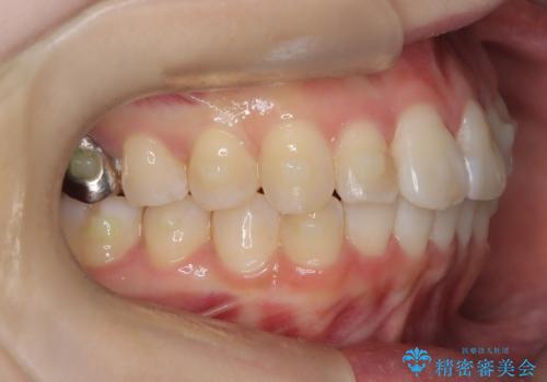 前歯のガタつきをマウスピース矯正で改善の治療中