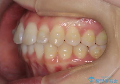 前歯のガタつきをマウスピース矯正で改善の治療中