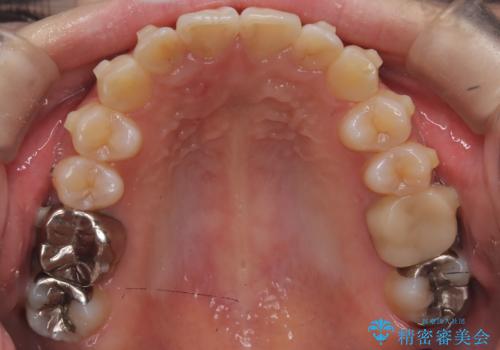 前歯のガタつきをマウスピース矯正で改善の治療中