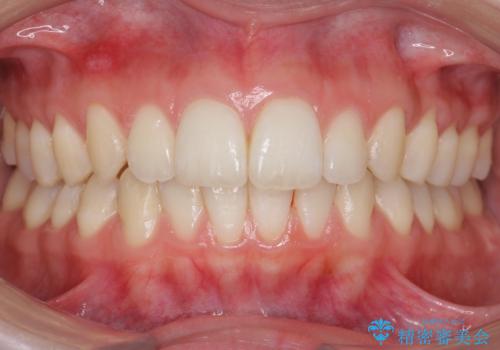 歯の着色を落としたいの症例 治療後